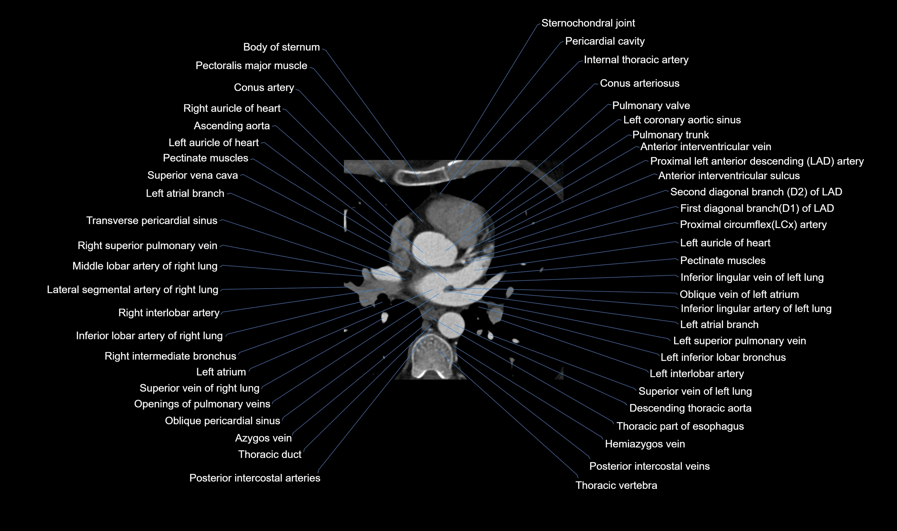 CT heart (coronary angiogram) axial view cross sectional anatomy labelled radiology image-00022.webp